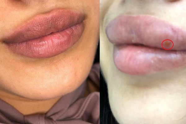 «Губы лопнули, гель потек»: косметолог изуродовал блогершу инъекциями красоты