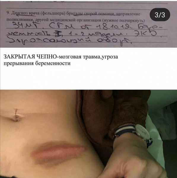 &laquo;Я могла потерять ребенка&raquo;: беременная косметолог обвинила блогершу в побоях