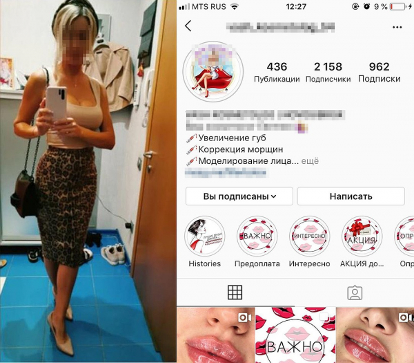 «У вас губы тугие, плохо тянутся»: косметолог изуродовала девушку уколами красоты «У вас губы тугие, плохо тянутся»: косметолог изуродовала девушку уколами красоты