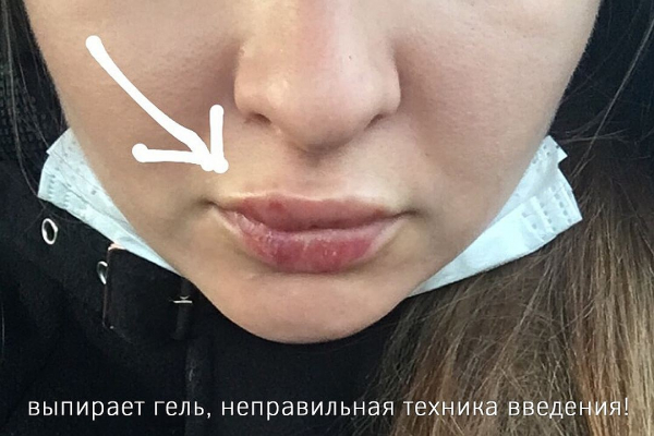 «У вас губы тугие, плохо тянутся»: косметолог изуродовала девушку уколами красоты «У вас губы тугие, плохо тянутся»: косметолог изуродовала девушку уколами красоты