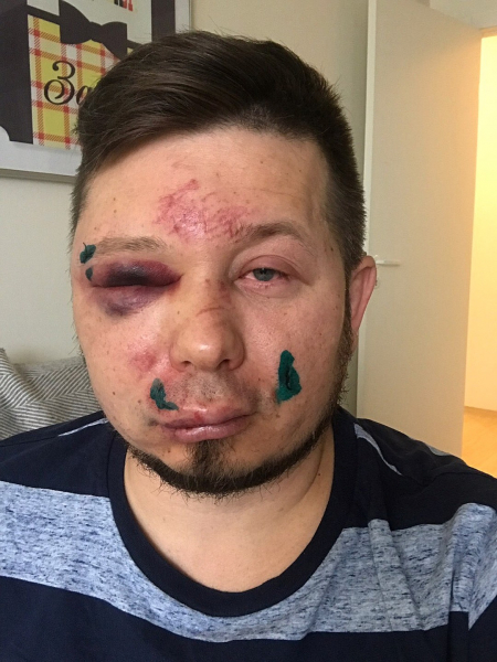 «Зашили бровь и губу, глаз не открывается»: в Новосибирске избили общественника, отстаивающего территорию военного городка «Зашили бровь и губу, глаз не открывается»: в Новосибирске избили общественника, отстаивающего территорию военного городка