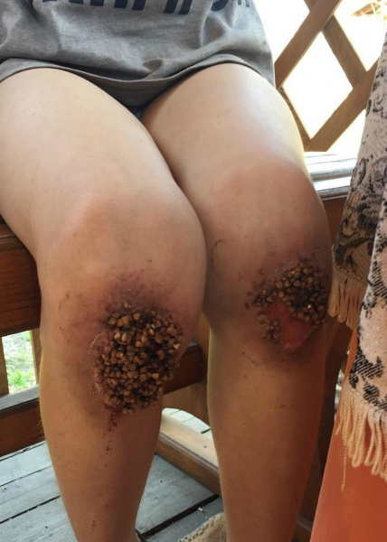 &laquo;Тетя, теперь меня заберут в нормальную семью?&raquo;: Паше, которого отчим и мать ставили на гречку, сделали операцию