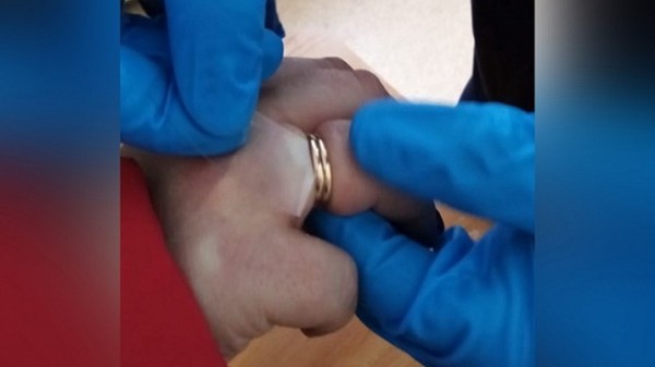 Три дня подряд спасатели снимали кольца с опухших пальцев новосибирцев Три дня подряд спасатели снимали кольца с опухших пальцев новосибирцев