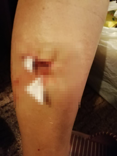 &laquo;Хозяева смотрели на это в окно&raquo;: собака покусала беременную женщину, но уколы от бешенства ей ставить нельзя