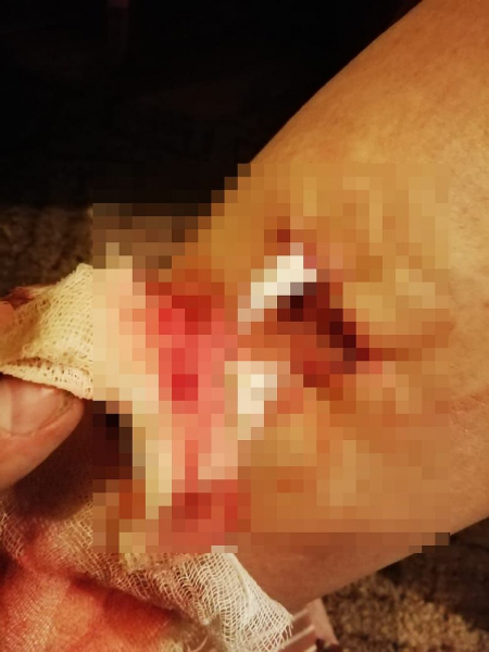 &laquo;Хозяева смотрели на это в окно&raquo;: собака покусала беременную женщину, но уколы от бешенства ей ставить нельзя