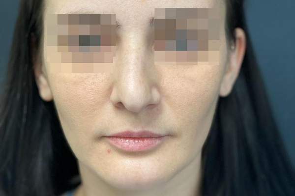 &laquo;У меня теперь разные ноздри, а кончик - как у Бабы-яги!&raquo;: пластический хирург изуродовал лицо сибирячке