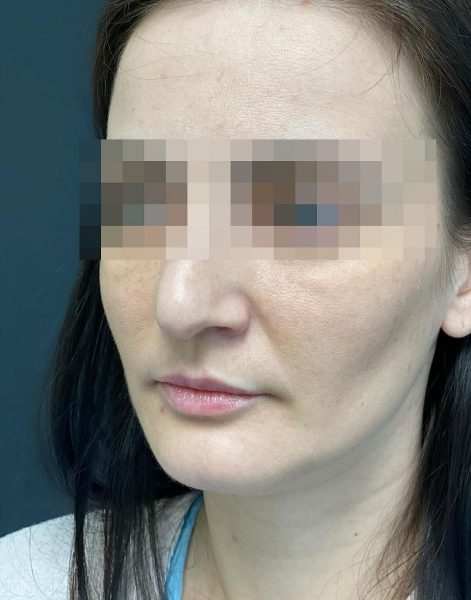 &laquo;У меня теперь разные ноздри, а кончик - как у Бабы-яги!&raquo;: пластический хирург изуродовал лицо сибирячке