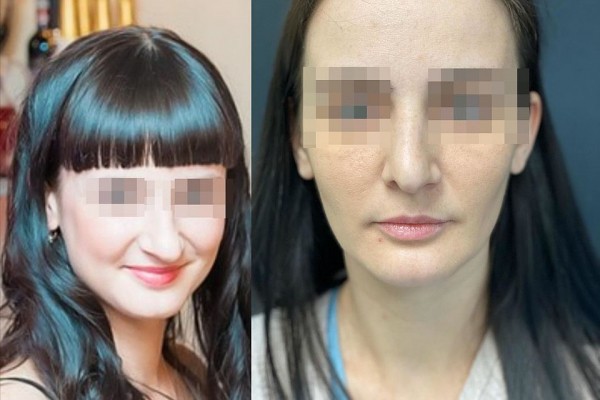 &laquo;У меня теперь разные ноздри, а кончик - как у Бабы-яги!&raquo;: пластический хирург изуродовал лицо сибирячке