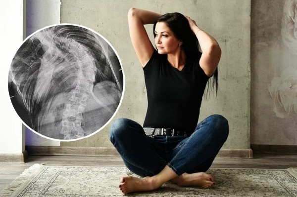 «У меня был натуральный горб»: новосибирские врачи выпрямили девушку, согнутую почти на 90 градусов «У меня был натуральный горб»: новосибирские врачи выпрямили девушку, согнутую почти на 90 градусов